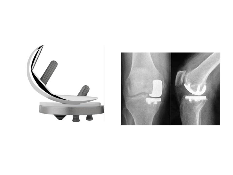 Read more about the article Unicomartmental Knee Replacement
