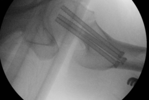 Cardinal rule with Neck of femur fractures: Donot accept mal reduction